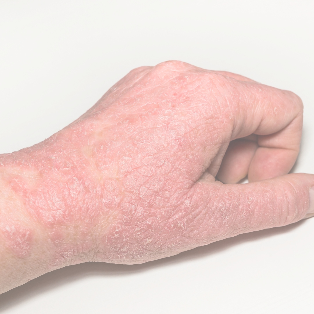 Eczema