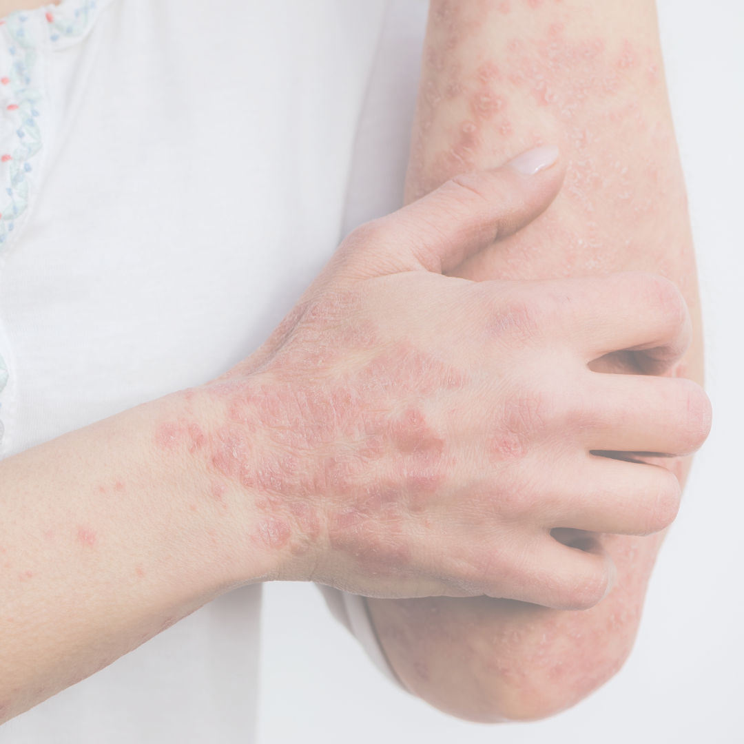 Psoriasis