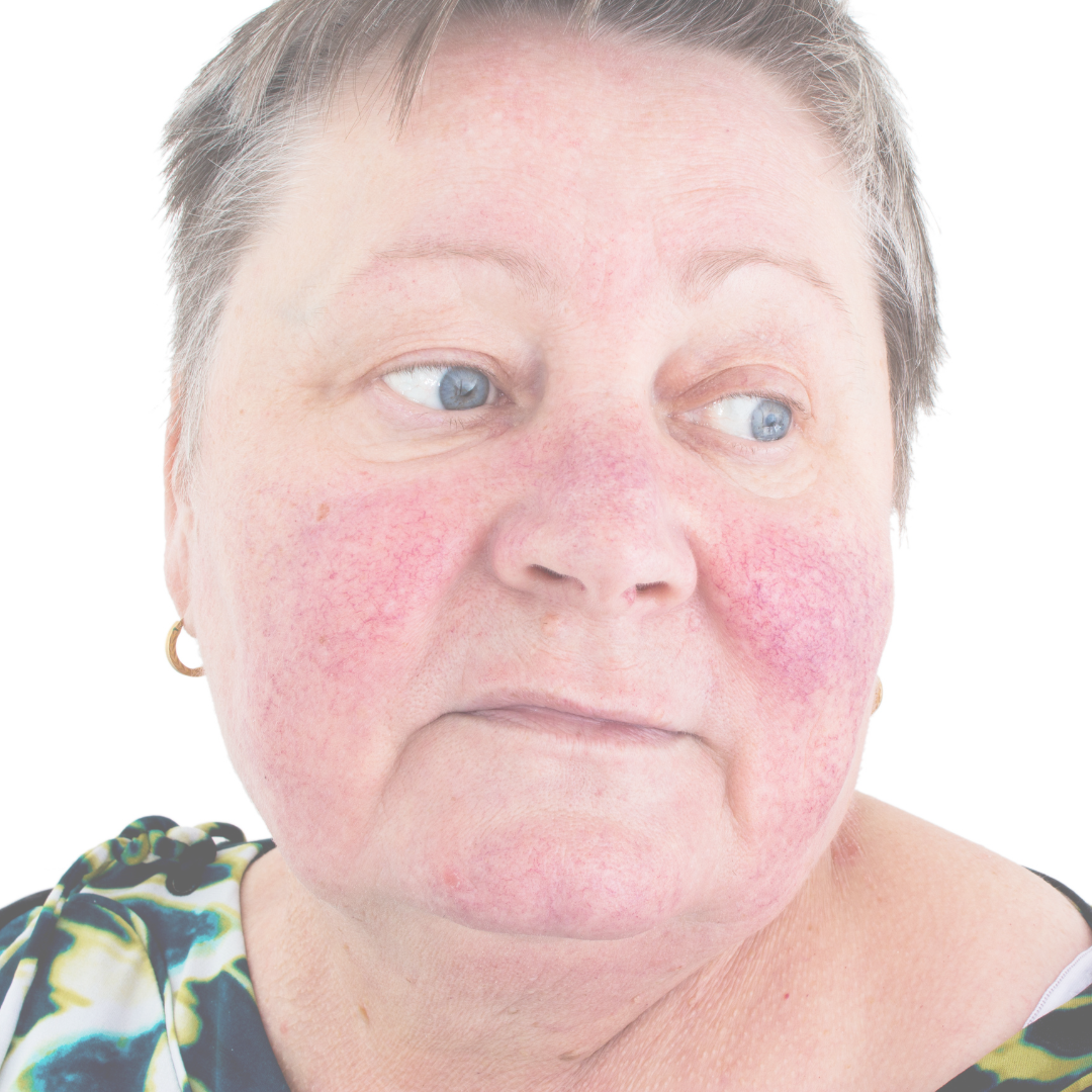 Rosacea